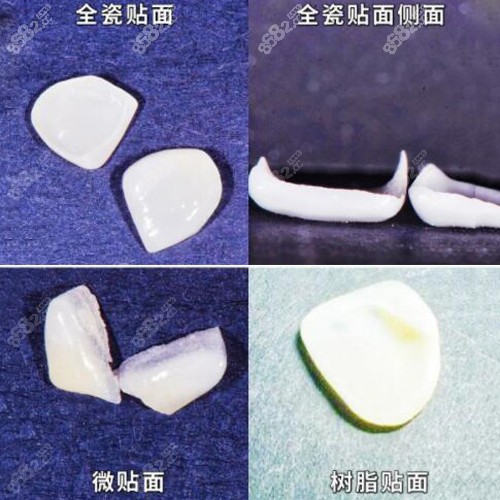 各种美容冠的材料