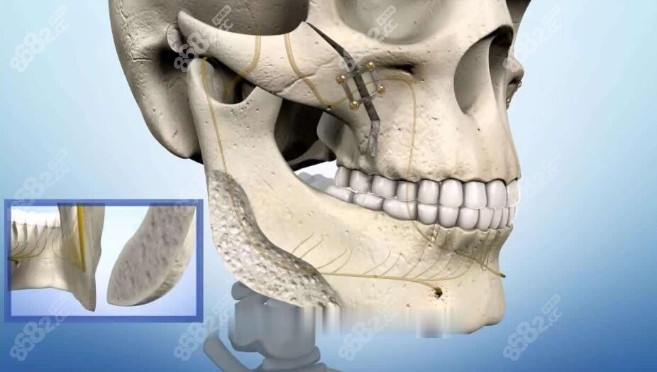 正颌手术去骨头示意图片