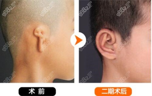 北京丽都安波外耳再造术前术后对比