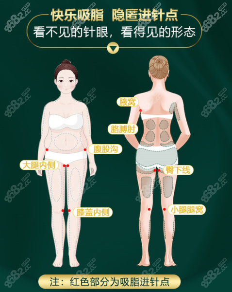 1,銀川麗都做大腿吸脂用到的抽脂儀器是水動力