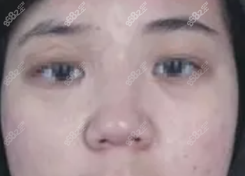 刘明章烫伤瘢痕术后