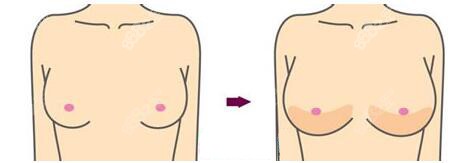 太原豐胸排名前三的醫(yī)院醫(yī)生