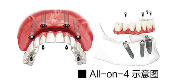 西安ALL-ON-4（6）种植牙的价格
