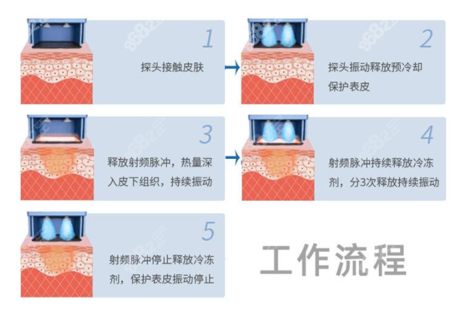 热玛吉五代操作过程