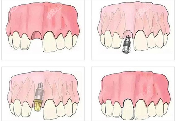 即刻种植牙的步骤图