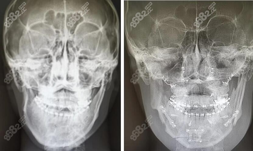 偏颌做正颌手术前后脸型改变对比图