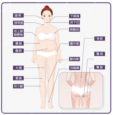 5g天使光雕可以吸脂的部位