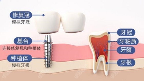 北京种植牙