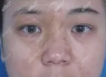 刘明章烫伤瘢痕术前