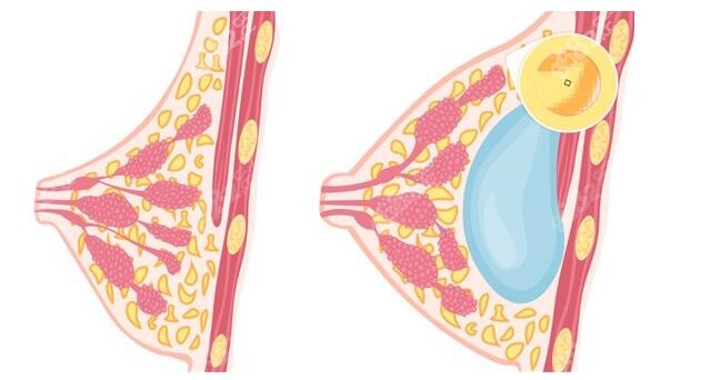 太原豐胸排名前三的醫(yī)生——王新燦