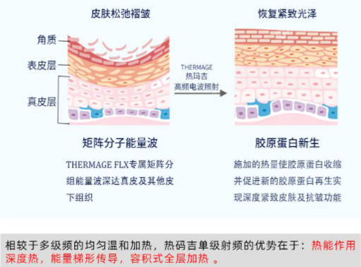 热玛吉五代功效怎么样