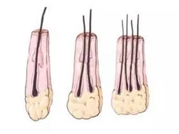 看，一个毛囊可能会长1根头发，也有可能是2根、3根、4根呦