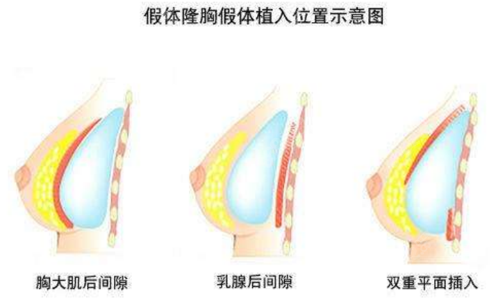 假体隆胸手术