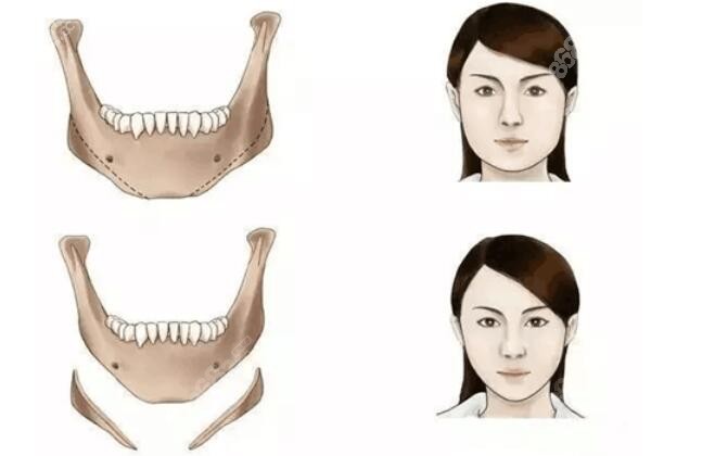 重庆华美磨骨前后脸型对比图