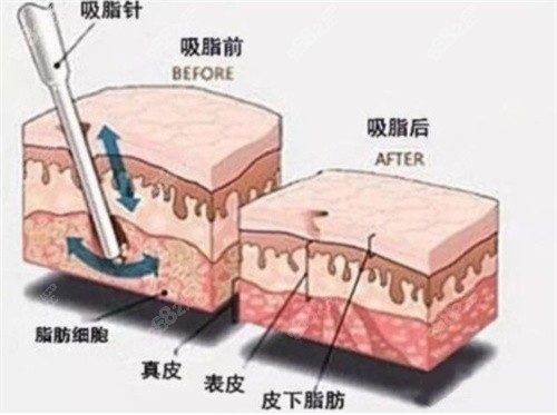 常州抽脂好医院就这五家，全身抽脂,大腿环吸都推荐