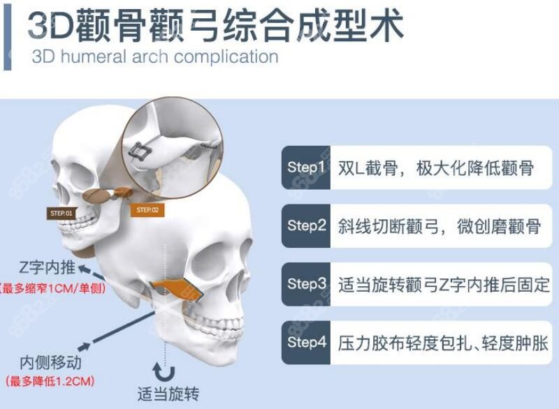 重庆时光颧骨手术特色