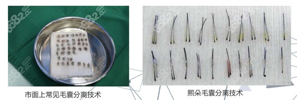 熙朵的毛囊分离技术对比