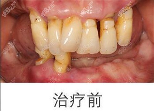 <!--<i data=20240705-sp></i>-->口腔多全口植前