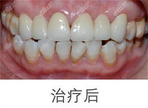<!--<i data=20240705-sp></i>-->口腔多颗种植后