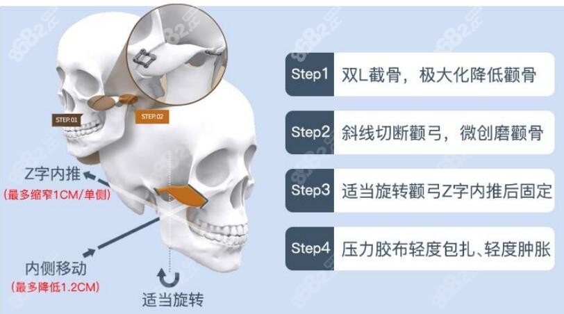 重庆时光<!--<i data=20240705-sp></i>-->磨颧骨技术特色