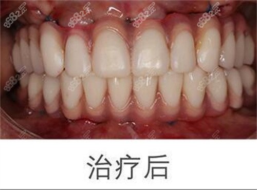 <!--<i data=20240705-sp></i>-->口腔多全口植后