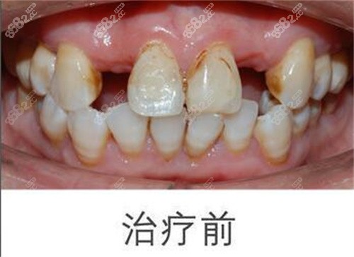 <!--<i data=20240705-sp></i>-->口腔多颗种植前