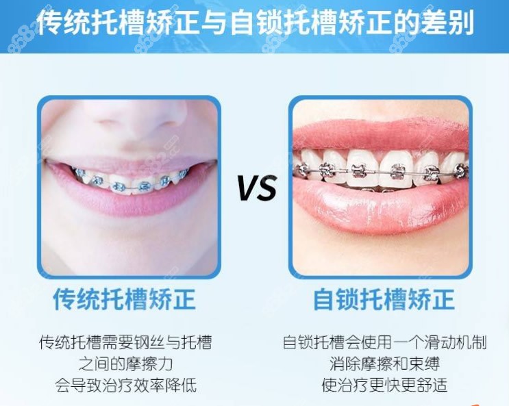 传统金属托槽与自锁托槽矫正的区别