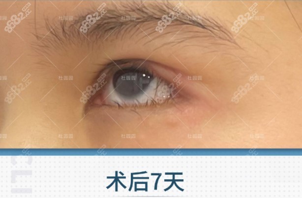 上海联合丽格杜园园修复双眼皮病例图