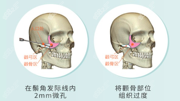 郑志雄颧骨手术