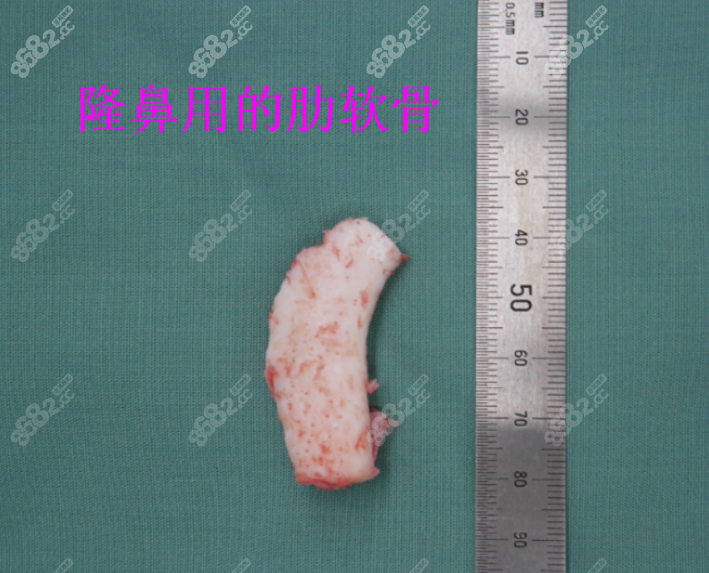 北京米兰柏羽丽都吴玉家做鼻子