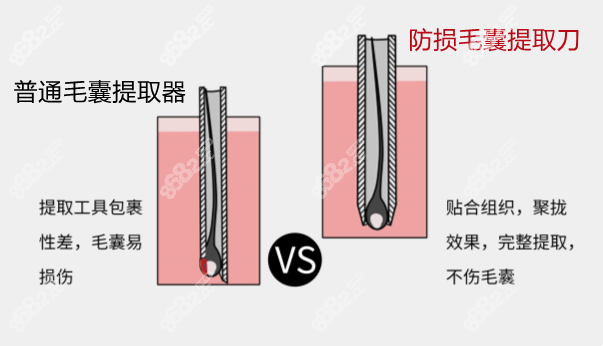 雷惠斌院长发明的毛囊防损提取刀可以有效减少毛囊损伤