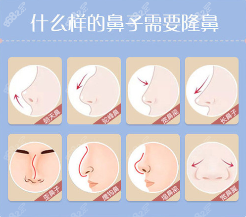 济南海峡整形假体隆鼻做得怎么样
