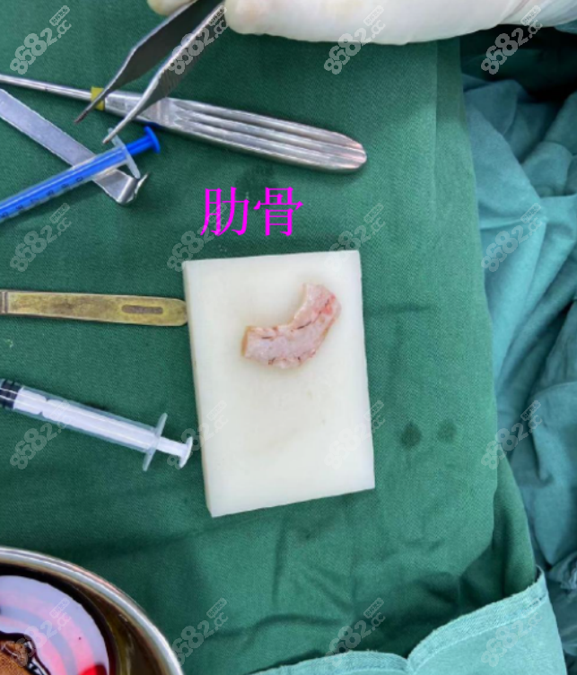 田秋梅医生隆鼻用到的肋软骨