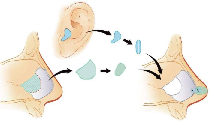 隆鼻軟骨取材展示圖