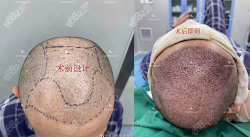 呼和浩特五洲植发怎么样