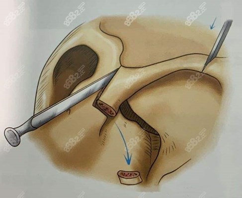 崔宇经颧骨内推技术