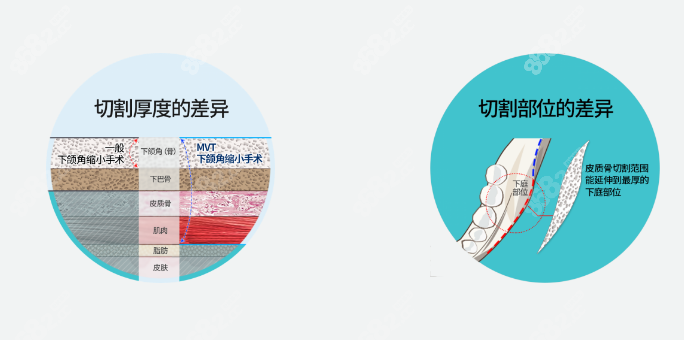 张立天下颌角切的多吗？