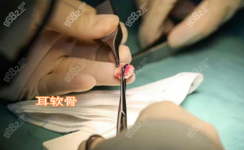吴玉家医生做鼻子用到的耳软骨