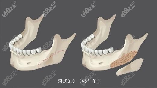 河东镐下颌角截骨第三代技术