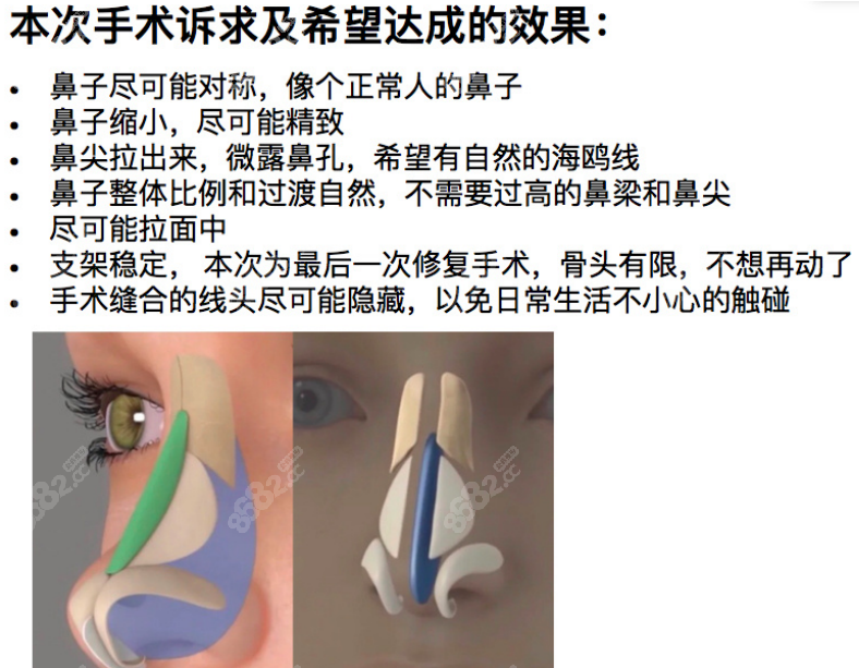 吴玉家医生做全鼻再造手术挺好的