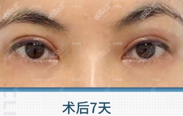 上海联合丽格杜园园修复双眼皮病例图