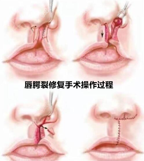 唇腭裂可以完全修复吗图片