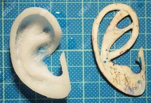 耳朵整形需要多少钱？