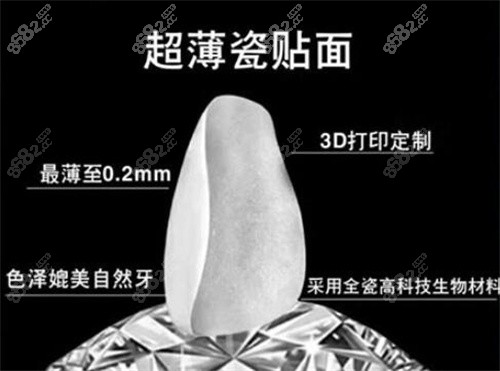 超薄牙贴面