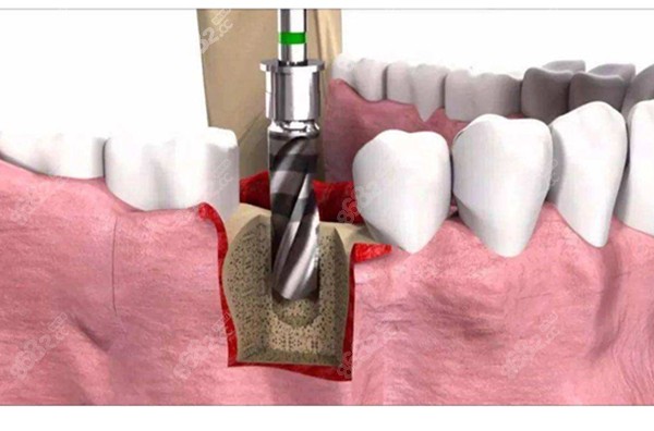 种植牙的过程图