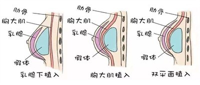 吴友勇医生隆胸的技术优势