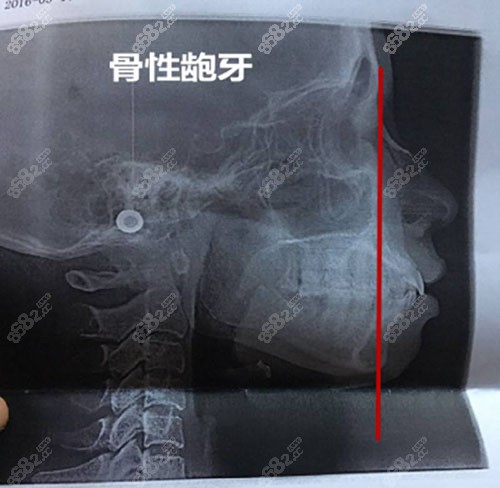 通过拍牙片来区分骨性龅牙和牙性龅牙