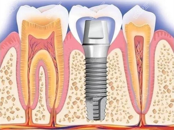 人工种植牙构造图