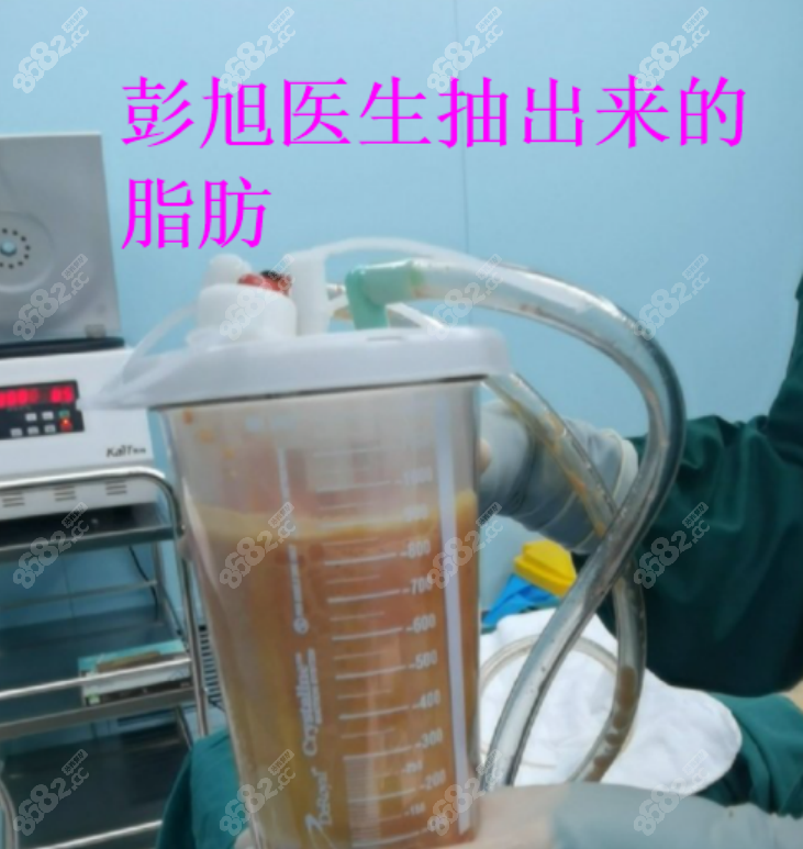 彭旭医生做吸脂手术抽出来的脂肪很干净