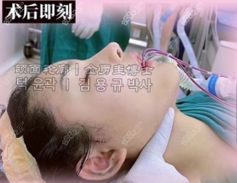 上海愉悦美联臣磨骨术后即刻 上海愉悦美联臣磨骨术后即刻